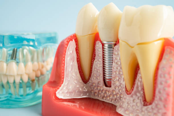 Best Wisdom Tooth Removal  in Pelican Bay, FL